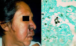 Paracoccidioidomicosis. Células multigemantes de Paracoccidioides brasiliensis en la biopsia (Grocott, 40×).