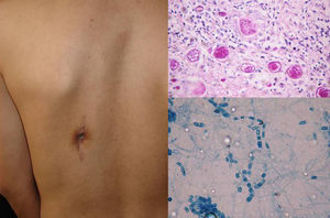 Fístula de coccidioidomicosis diseminada. Esférulas en la biopsia (PAS, 40×) y artroconidios de Coccidioides immitis (azul de algodón, 40×).
