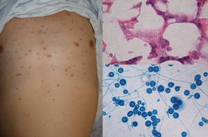 Lesiones papulares de histoplasmosis cutánea diseminada en paciente con sida. Levaduras intracelulares en la biopsia (H&E, 100×) y examen directo de conidios espiculados de Histoplasma capsulatum (azul de algodón, 40×).