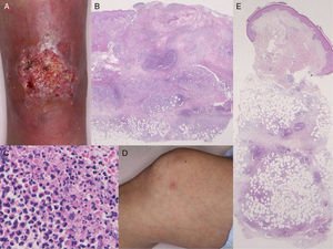 (A) Deep ulcerative lesions on the lower leg. (B) Histological features showing a dense neutrophil infiltrate in the upper to mid-dermis. Hematoxylin and eosin (H&E), original magnification ×40. (C) Higher magnification reveals prominent neutrophil infiltration and extravasation of red blood cells. H&E, original magnification ×400. (D) Painful, subcutaneous erythematous nodules on the knee. (E) Histology shows cellular infiltrates most intense in the subcutaneous septa. H&E, original magnification ×40.
