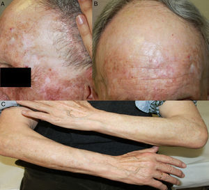 A y B) Retroceso de implantación del pelo frontal y temporal, con una piel más fina y pálida, y oclusión de las aperturas foliculares. C) Alopecia de antebrazos.