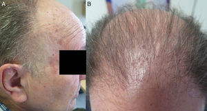 A y B) AGA grado vi de Hamilton, con una banda de piel más fina y con borramiento de los orificios foliculares a nivel bitemporal, y presencia de eritema e hiperqueratosis perifolicular fronto-parietal.