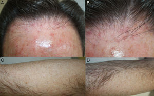 A) Evidente retroceso de la línea de implantación del pelo a nivel frontal, en un paciente sin AGA de base. B) Intenso eritema e hiperqueratosis perifolicular. C y D) Placas alopécicas en ambas extremidades superiores.