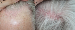 A) Retroceso de la línea de implantación del pelo, con eritema e hiperqueratosis perifolicular. B) Áreas parcheadas de alopecia cicatricial parietal típicas de LPF.