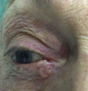 Carcinoma basocelular canto interno.
