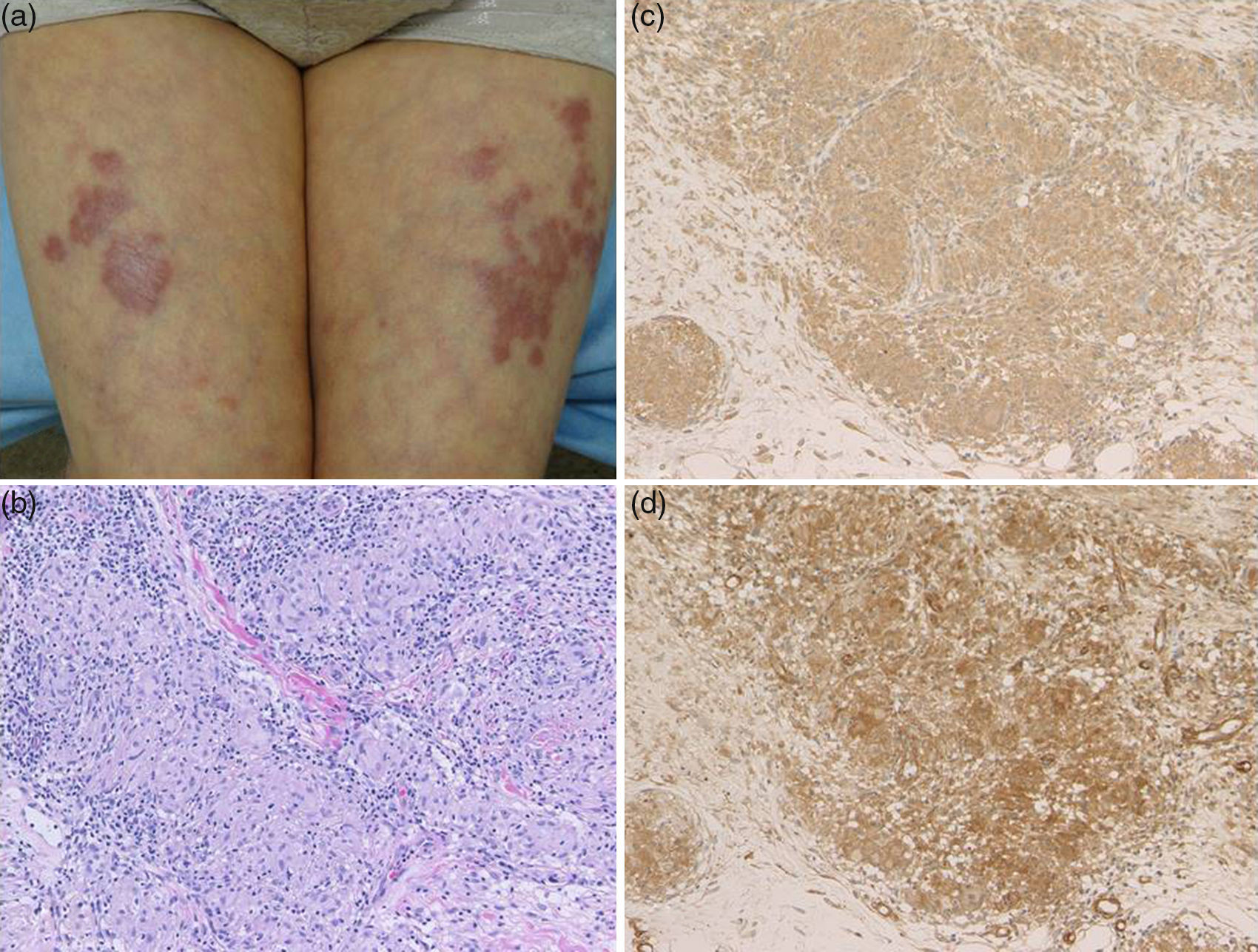 Levidoid Rash Cutaneous Sarcoid with Livedoid Changes in a Patient with Hashimoto's ...