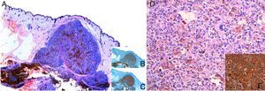 A) Panorámica hematoxilina-eosina. B) Inmunohistoquímica con Melan-A. C) Inmunohistoquímica con S100. D) Hematoxilina-eosina ×20. E) Inmunohistoquímica con HMB45.