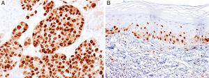 Immunohistochemical study for microphthalmia-associated transcription factor (MITF). (A) Invasive melanoma diffusely positive nuclear labeling in melanocytic lesions with epithelioid melanocytes (magnification 200×). (B) Melanoma in situ, with contiguous proliferation and suprabasal spread of atypical melanocytes (magnification 200×).