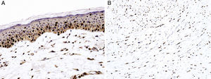 Immunohistochemical study for SOX10. (A) Melanoma in situ, with contiguous proliferation and suprabasal spread of atypical melanocytes (magnification 200×). (B) Desmoplastic melanoma with diffusely positive nuclear expression (magnification × 100).