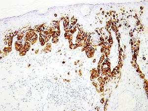Immunohistochemical study using melanocytic cocktail (HMB45 and anti-tyrosinase) highlights intraepidermal and dermal components of this superficial spreading melanoma (magnification × 100).