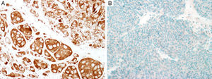 Immunohistochemical study for BRAF V600E. (A) Diffuse cytoplasmic positivity, indicating the presence of BRAF V600E mutation in the majority of cells (magnification 200×). (B) Negative stain, indicating wild type BRAF status (magnification × 200).