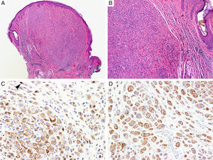 Immunohistochemical studies for BAP1 and BRAF in a ‘BAPoma’. (A) Hematoxylin and eosin stained section of a dome-shaped BAPoma with dense proliferation of epithelioid melanocytes within the dermis (magnification 40×). (B) Typical nevus cells are also present at the peripheral of epithelioid proliferation (right side, magnification 100×). (C) Diffuse loss of nuclear BAP1 in most of the melanocytes; arrowhead indicates single positive cell. Of note, the background cytoplasmic reaction should not be interpreted as positive (magnification 200×). (D) These cells are diffusely positive for BRAF V600E protein (magnification × 200).