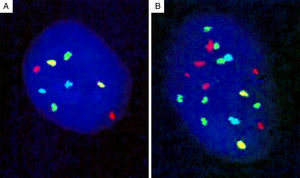 Four-probe FISH assay. (A) Normal cell with two signals each of 6p25 (RREB1, red), 6q23 (MYB, gold), 11q13 (CCND1, green), and centromere 6 (Cep6, aqua). (B) Melanoma cell with an abnormal FISH result with multiple RREB1 (6 red dots) and CCND1 signals (7 green dots), indicating gains at 6p25 and 11q13, respectively.