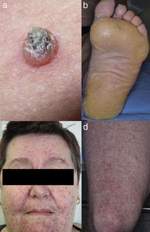 BRAFi induced (a) SCC, (b) plantar keratoderma, MEKi induced (c) acneiform eruption, and BRAFi and MEKi induced (d) folliculitis.