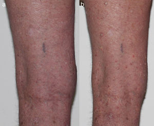 (a) Baseline photo prior to starting BRAFi and (b) multiple VKs on bilateral lower limbs 5 weeks post starting BRAFi.