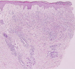 Histopathology showing dense inflammatory cell infiltrates through the dermis, mainly composed of neutrophils (hematoxylin and eosin stain, original magnification ×40).