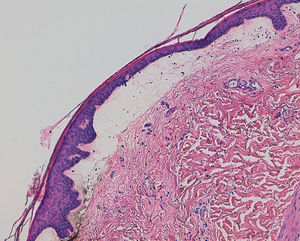 Ampolla subepidérmica con preservación de la capa basal (H&E, ×20).