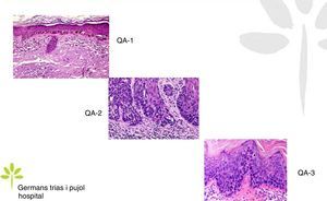 Gradación histopatológica de las queratosis actínicas.
