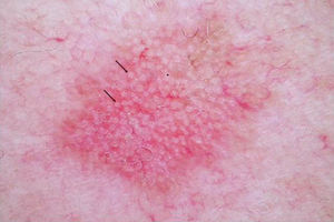 Examen dermatoscópico de una queratosis actínica. Típica imagen «en fresa».