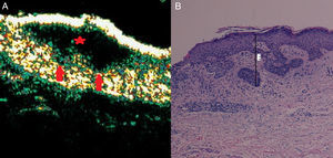 Carcinoma basocelular mixto (superficial e infiltrativo). A) Modo B (20Mhz) corte longitudinal. Se observa una imagen anecoica, aplanada y heterogénea a nivel subepidérmico con bordes irregulares pero bien definida (estrella roja), pero que presenta 2 prolongaciones en el extremo derecho hacia dermis subyacente (flechas rojas) y que corresponden a focos de infiltración. B) Imagen histológica del tumor (H-E×4).