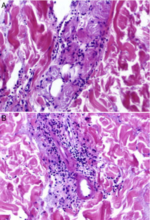 A) Focos de necrosis del epitelio glandular en los ovillos ecrinos con infiltración periglandular neutrofílica. Hematoxilina-eosina, ×20. B) Infiltrados dérmicos, tanto perivasculares como perianexiales, de predominio neutrofílico, y focos de necrosis fibrinoide en la pared de capilares dérmicos con infiltración neutrofílica de la misma. Hematoxilina-eosina, ×20.