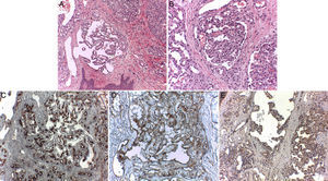 Estudio anatomopatológico de pápula de escote. A) Múltiples formaciones de aspecto glomeruloide a nivel dérmico (hematoxilina-eosina x10). B) Imagen a mayor detalle (hematoxilina-eosina x20). C) Tinción CD 34+ exclusivamente a nivel de los vasos capilares (hematoxilina-eosina x20). D) Tinción CD31+ de vasos sinusoidales y capilares del hemangioma glomeruloide (hematoxilina-eosina x20). E) Tinción VEGF+ presente a nivel de ambos tipos de vasos (hematoxilina-eosina x20).