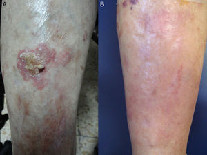 Mujer de 90 años con linfoma sistémico en tratamiento con quimioterapia con lesión de enfermedad de Bowen en la cara anterior de la pierna derecha (A). Tras 3 ciclos de TFD con MAL presenta respuesta completa de la lesión sin recidiva durante el seguimiento (B).