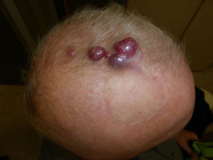 Recidiva local de un carcinoma de Merkel.