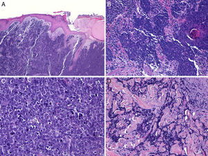 Histología de un carcinoma de células de Merkel con un patrón infiltrativo. A: tumoración en dermis con epidermis conservada (Hematoxilina-eosina × 100); B: la tumoración infiltra ampliamente la dermis (hematoxilina-eosina × 200). C: células atípicas, pequeñas, redondas y basófilas (hematoxilina-eosina × 400). D: infiltración de la tumoración entre los haces de colágeno (hematoxilina-eosina × 200).