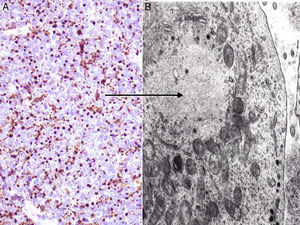Inmunohistoquímica del carcinoma de células de Merkel. A: tinción citoplasmática positiva de la citoqueratina 20 con una disposición característica paranuclear (dot-like). B: microscopia electrónica de una célula tumoral donde se aprecian todos los filamentos intermedios agrupados.