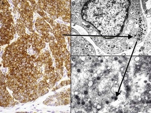 Inmunohistoquímica del carcinoma de células de Merkel. A: tinción inmunohistoquímica de diferenciación neuroendocrina (cromogranina) con la tinción citoplasmática granular característica. B y C: microscopia electrónica que corresponde a los gránulos electrodensos dispersos en el citoplasma que presentan las células tumorales del CCM.