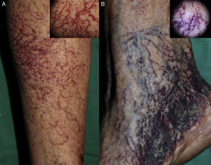 Comparación clínica y dermatoscópica de lesiones telangiectáticas recientes A) y antiguas B). Con el paso del tiempo, adquisición de morfología más tortuosa de los vasos, de color más oscuro y asociado a hiperqueratosis B).