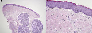 (A) Oral mucosa biopsy specimen showing hyalinization and fibrosis of the submucosa with a mild submucosal inflammatory infiltrate (hematoxylin–eosin, original magnification ×40). (B) Epithelial atrophy without dysplasia and mild hyperkeratosis. Scattered mononuclear cell infiltration and pigment incontinence in the submucosa (hematoxylin–eosin, original magnification ×200).