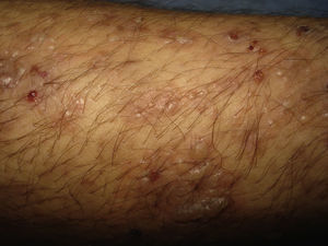 Vesículas agrupadas en ramilletes, que asientan sobre piel sana o eritematosa. Costras y erosiones localizadas en pierna derecha.