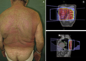 A. Fenómeno de recall en paciente irradiado por sarcoma de partes blandas. B. Planificador donde se aprecia campo de irradiación.