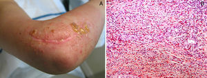 A. Múltiples vesículas y ampollas en zona irradiada por tumor epitelioide de vaina de nervio periférico. B. Denso infiltrado inflamatorio con numerosos eosinófilos (hematoxilina-eosina x10).