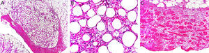 A. Paniculitis de predominio lobulillar (hematoxilina-eosina x10). B. Histiocitos espumosos rodeando los adipocitos (hematoxilina-eosina x40). C. Engrosamiento y esclerosis de los septos hipodérmicos (hematoxilina-eosina x10). Imágenes cedidas por el Doctor Luis Requena Caballero.