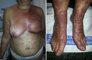 A. Cuadro de eritema multiforme con afectación predominante inicial en la zona irradiada por carcinoma de mama previo. B. Posterior extensión en forma de dianas atípicas.
