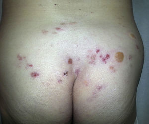 Múltiples ampollas tensas de contenido seroso en la zona irradiada, compatibles con penfigoide ampolloso radioinducido.