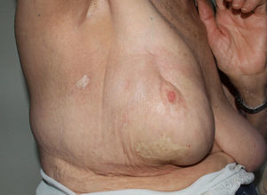 Morfea posradioterapia en paciente con antecedente de carcinoma de mama derecha. Imagen cedida por el Doctor José Antonio Avilés Izquierdo.