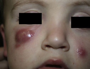 Nódulos eritematovioláceos asintomáticos en párpado inferior derecho y en mejilla izquierda.