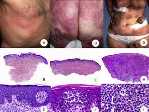 Micosis fungoide clásica. A. Imagen clínica de lesiones de micosis fungoide en fase de parche. B, C. Hallazgos histopatológicos típicos de la fase de parche que muestran infiltrado de linfocitos atípicos en dermis papilar con epidermotropismo. D. Imagen clínica de lesiones de micosis fungoide en fase de placa. E, F. Hallazgos histopatológicos típicos de la fase de placa que muestran hallazgos similares a los de la fase de parche, pero con un infiltrado linfocitario más denso, de distribución liquenoide, dispuesto en banda en la dermis superficial, e intenso epidermotropismo con formación de «microabscesos de Darier-Pautrier». G. Imagen clínica de lesiones de micosis fungoide en fase tumoral. H, I. Hallazgos histopatológicos típicos de la fase tumoral que muestran un infiltrado linfocitario difuso compuesto por linfocitos grandes y pleomórficos que ocupa todo el espesor de la dermis.