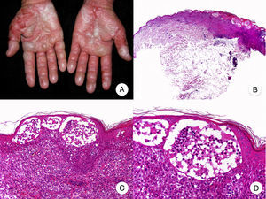 Micosis fungoide ampollar. A. Imagen clínica que muestra lesiones vesiculoampollosas afectando de forma simétrica a ambas manos. B. Vista panorámica que muestra ampollas intraepidérmicas. C, D. Detalle de las ampollas, con linfocitos atípicos en la dermis papilar y epidermotropismo.