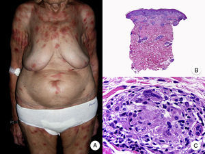 Micosis fungoide granulomatosa. A. Imagen clínica de lesiones de micosis fungoide en fase de parche y placa dispersas por el tronco y las extremidades. B. Vista panorámica que muestra granulomas perivasculares de tipo sarcoideo afectando a todo el espesor de la dermis. C. Detalle de un granuloma compuesto por linfocitos atípicos, histiocitos y células gigantes multinucleadas.