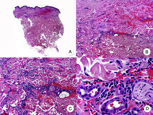 Micosis fungoide intersticial. A. Vista panorámica que muestra un leve infiltrado en la dermis. B. A mayor aumento se observa que el infiltrado se dispone siguiendo un patrón intersticial. C, D. Detalle del infiltrado de predominio linfocitario que se dispone entre los haces de colágeno y otras estructuras anexiales de la dermis.