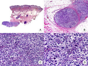 Micosis fungoide con transformación en células grandes. A. Vista panorámica que muestra una biopsia de cuero cabelludo con infiltración parcheada de la dermis. B. Detalle del infiltrado neoplásico en la hipodermis. C, D. A mayor aumento se observa que el infiltrado está compuesto por células neoplásicas grandes, pleomórficas y anaplásicas.