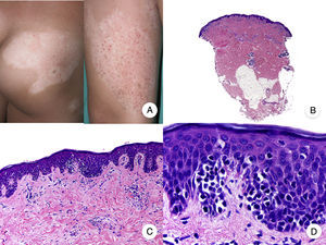 Micosis fungoide hipopigmentada. A. Imágenes clínicas que muestran máculas y placas hipopigmentadas con ausencia de atrofia cutánea en un niño. B. Vista panorámica que muestra un infiltrado a nivel de la dermis superficial. C, D. Detalle del infiltrado dérmico con linfocitos atípicos y epidermotropismo.