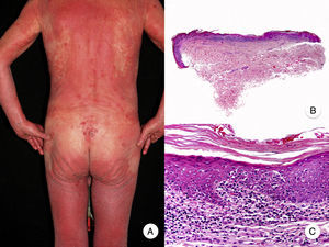 Micosis fungoide eritrodérmica. A. Imagen clínica que muestra eritrodermia en un paciente, coexistiendo con placas y tumores de micosis fungoide. B, C. Histopatológicamente se observa un infiltrado inflamatorio en la dermis papilar con linfocitos ligeramente atípicos y epidermotropismo.