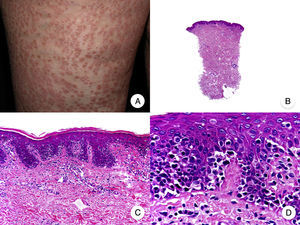 Micosis fungoide papular. A. Imagen clínica que muestra pápulas de pequeño tamaño no foliculocéntricas en las extremidades inferiores. B. Vista panorámica que muestra un infiltrado leve en la dermis papilar. C, D. Detalle del infiltrado dérmico con linfocitos atípicos y epidermotropismo.