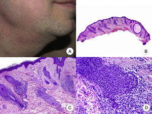 Micosis fungoide foliculotropa. A. Imagen clínica que muestra pápulas foliculares y lesiones acneiformes en la cara y el cuello. B. Vista panorámica que muestra un infiltrado rodeando los folículos pilosos. C, D. A mayor aumento se observan linfocitos atípicos agrupados en el seno del epitelio de la vaina radicular externa del folículo piloso.